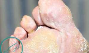 Чем и как лечить грибок на пальцах ног: советы и рекомендации