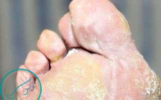 Чем и как лечить грибок на пальцах ног: советы и рекомендации