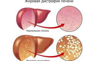 Жировая дистрофия печени