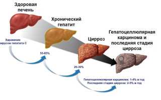 Гепатит печени
