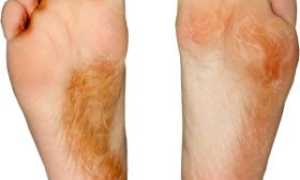 Правильное лечение грибка на ногах в домашних условиях: советы и рекомендации