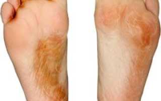 Правильное лечение грибка на ногах в домашних условиях: советы и рекомендации