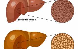 Жировой гепатоз поджелудочной железы