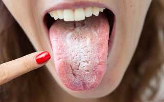 Кандидоз в полости рта на языке: причины и лечение