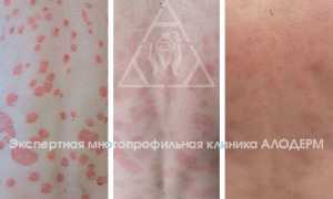 Стоит ли загорать при псориазе на солнце или в солярии для здоровья кожи?