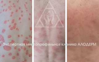 Стоит ли загорать при псориазе на солнце или в солярии для здоровья кожи?