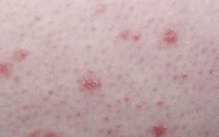 Начальная стадия псориаза