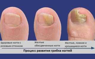 Использование мазей от грибка на ногах — проверенные средства для эффективного лечения