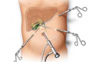 Если удален желчный пузырь