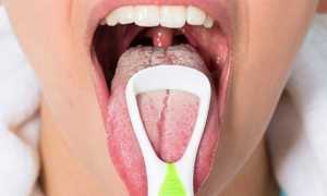ТОП эффективных методов лечения кандидоза полости рта в домашних условиях