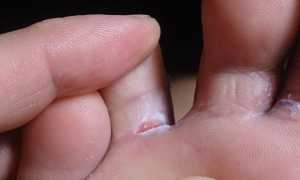 Какими способами или препаратами лечить трещины между пальцами ног эффективно и безопасно