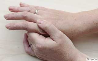 Симптомы и лечение псориатического артрита