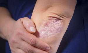 Действительно ли псориаз заразен для окружающих и как это влияет на жизнь?