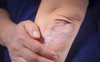 Действительно ли псориаз заразен для окружающих и как это влияет на жизнь?