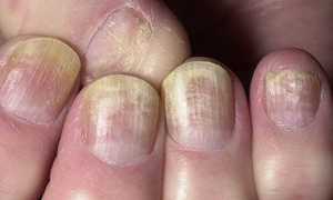 Способы лечения грибка мазью Клотримазол в домашних условиях