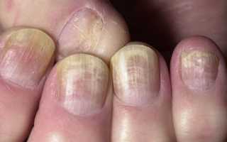 Способы лечения грибка мазью Клотримазол в домашних условиях