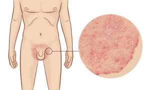 Что нужно сделать, если на члене псориаз? Полезные советы и рекомендации.