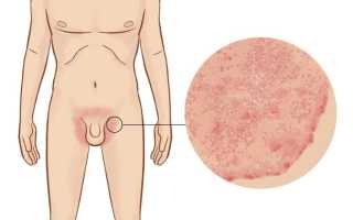 Что нужно сделать, если на члене псориаз? Полезные советы и рекомендации.