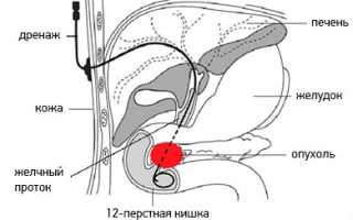 Механическая желтуха лечение