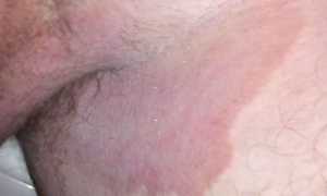 Что такое паховый грибок и как с ним бороться? Полезные советы и рекомендации