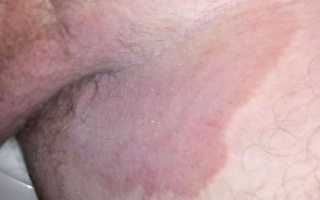 Что такое паховый грибок и как с ним бороться? Полезные советы и рекомендации