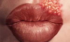 Почему появляется грибок на губах и как нужно с ним бороться: советы и рекомендации