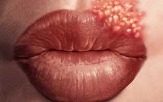 Почему появляется грибок на губах и как нужно с ним бороться: советы и рекомендации