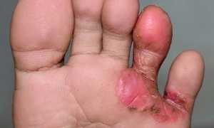 Поражение кожи — межпальцевая грибковая эрозия. Диагностика и лечение заболеваний