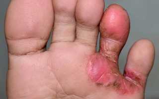 Поражение кожи — межпальцевая грибковая эрозия. Диагностика и лечение заболеваний