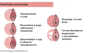 Зуд в области интимных зон у женщин как симптом молочницы: причины и лечение