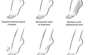 Основные принципы лечения грибка стопы при беременности и их важность