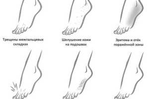 Основные принципы лечения грибка стопы при беременности и их важность