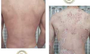 Что такое ПУВА терапия и как она может помочь при псориазе? Узнайте больше о методах лечения