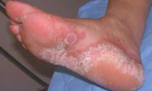 Все что нужно знать о грибке на ступнях и его лечении