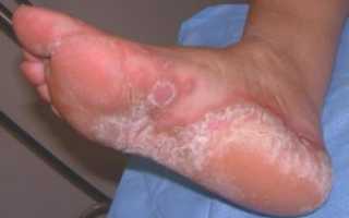 Все что нужно знать о грибке на ступнях и его лечении