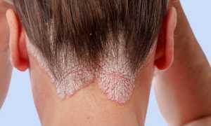 Эффективные методы и препараты для лечения грибка на голове в домашних условиях