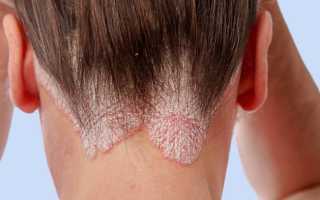 Эффективные методы и препараты для лечения грибка на голове в домашних условиях