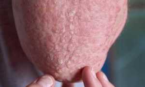 Как избавиться от грибка на мошонке: эффективные методы и советы