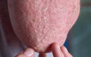 Как избавиться от грибка на мошонке: эффективные методы и советы