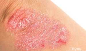 Хроническое поражение кожных покровов — псориаз на локтях: причины и лечение