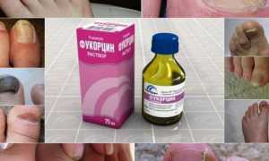 Можно ли использовать белизну для лечения грибка ногтей на ногах? Мнение специалистов