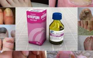 Можно ли использовать белизну для лечения грибка ногтей на ногах? Мнение специалистов