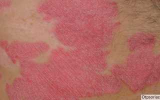 Психосоматика псориаза – психологические факторы чешуйчатого лишая