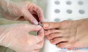 В какой последовательности проводится анализ на грибок ногтей для точной диагностики