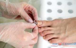 В какой последовательности проводится анализ на грибок ногтей для точной диагностики