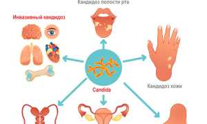 Опасное инфекционное заболевание Кандидоз легких: симптомы и лечение