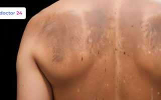 Из-за чего появляется солнечный грибок и как его лечить: советы и рекомендации