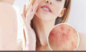 Поражение кандидозом кожного покрова лица: причины и лечение