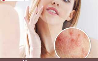 Поражение кандидозом кожного покрова лица: причины и лечение