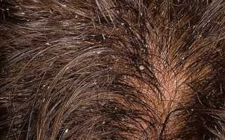 Себорейный псориаз – чем лечить, причины возникновения?